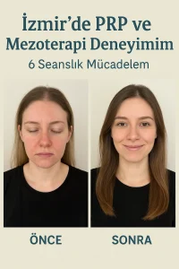 İzmir’de PRP ve Mezoterapi Deneyimim: 6 Seanslık Mücadelem